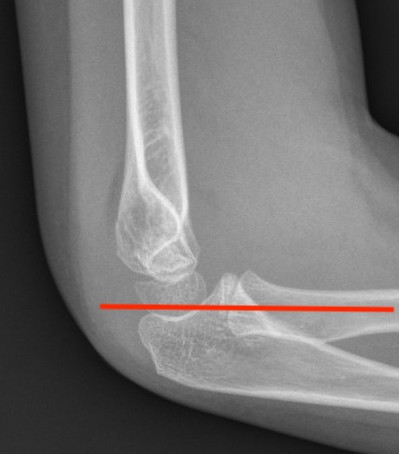 Radiohumeral Line